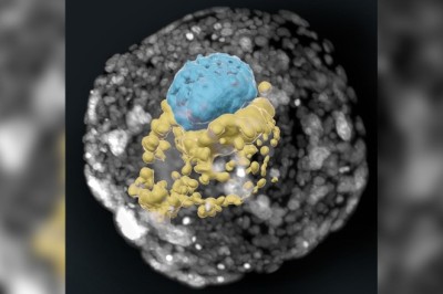 FDA considers first CRISPR gene editing treatment that may cure sickle cell